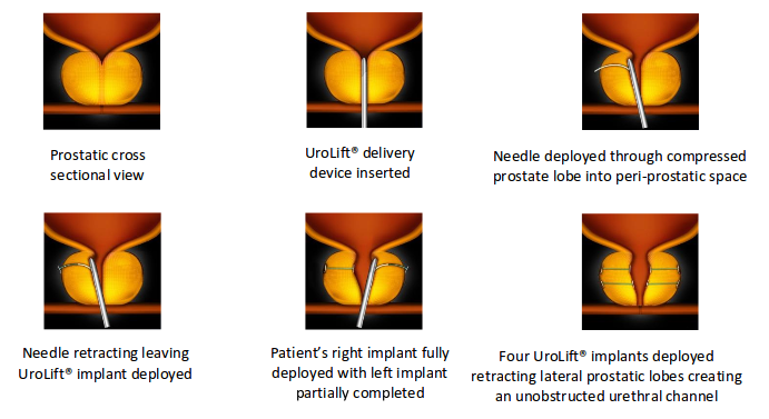 UroLift The Sydney Prostate and Kidney Centre