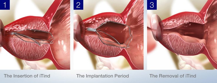 sydney-prostate-cancer-centre-robotic-prostate-surgery-and-prostate