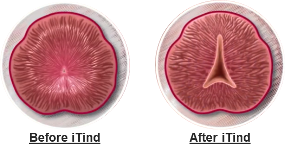 iTind mechanism of action