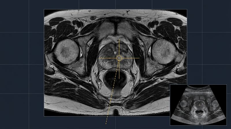 MRI-guided transperineal biopsy targeting view