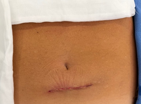 Single Port Incision Example