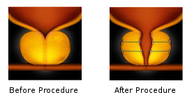 UroLift system for BPH